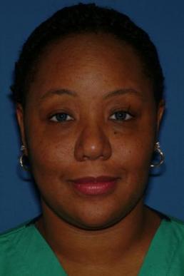 rhinoplasty-germantown