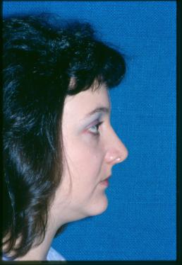 rhinoplasty-germantown