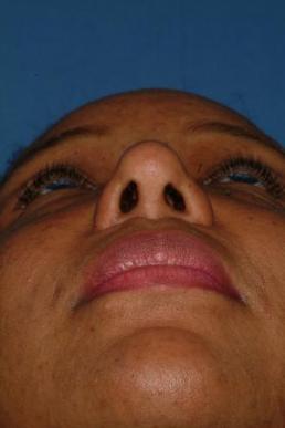 rhinoplasty-germantown