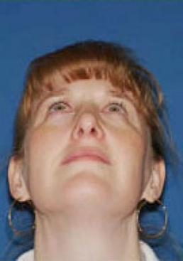 rhinoplasty-germantown