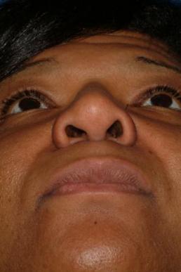 rhinoplasty-germantown