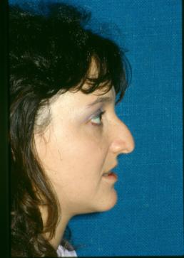rhinoplasty-germantown