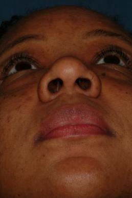 rhinoplasty-germantown