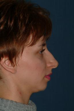 rhinoplasty-germantown