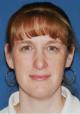 rhinoplasty-germantown