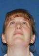 rhinoplasty-germantown