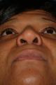rhinoplasty-germantown