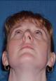 rhinoplasty-germantown