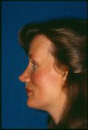 rhinoplasty-germantown