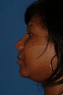 rhinoplasty-germantown