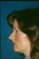 rhinoplasty-germantown