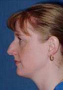 rhinoplasty-germantown