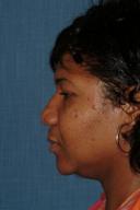 rhinoplasty-germantown